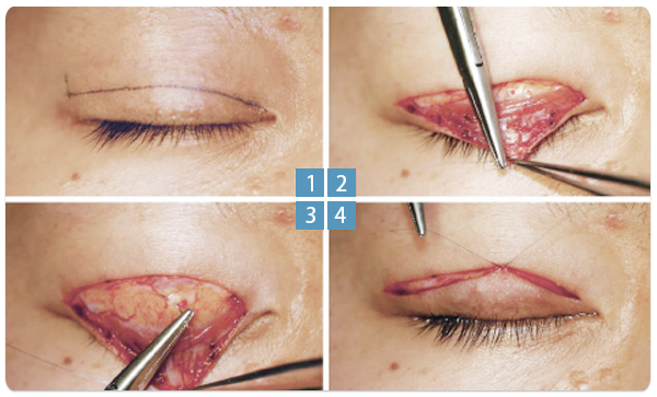 雙眼皮手術縫合過程