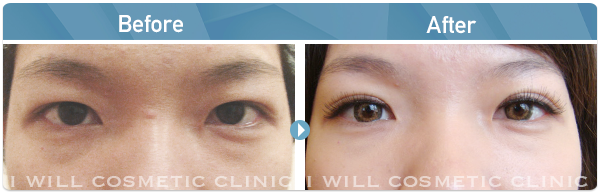 雙眼皮推薦案例