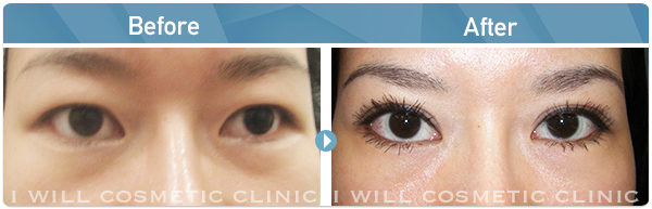 雙眼皮案例分享