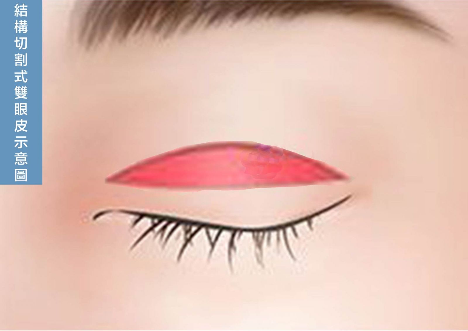 結構式雙眼皮手術示意圖