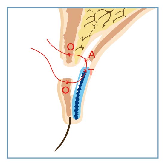 無疤雙眼皮手術