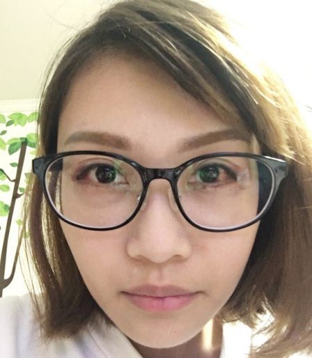 眼睛放大术 开眼尾 内.外眼睑下置术