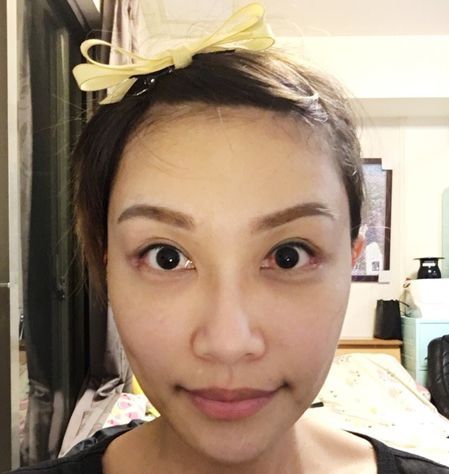 眼睛放大术 开眼尾 内.外眼睑下置术